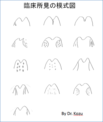 神津仁の名論卓説｜新しい咽頭所見の観察法｜e-doctor