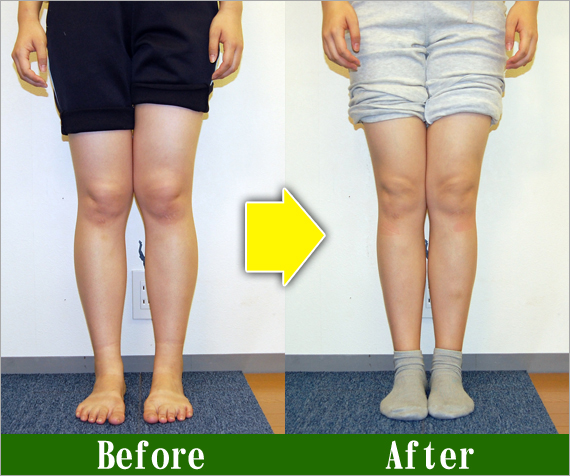 X脚矯正について | O脚矯正の改善事例100名以上・京都二条のトオル
