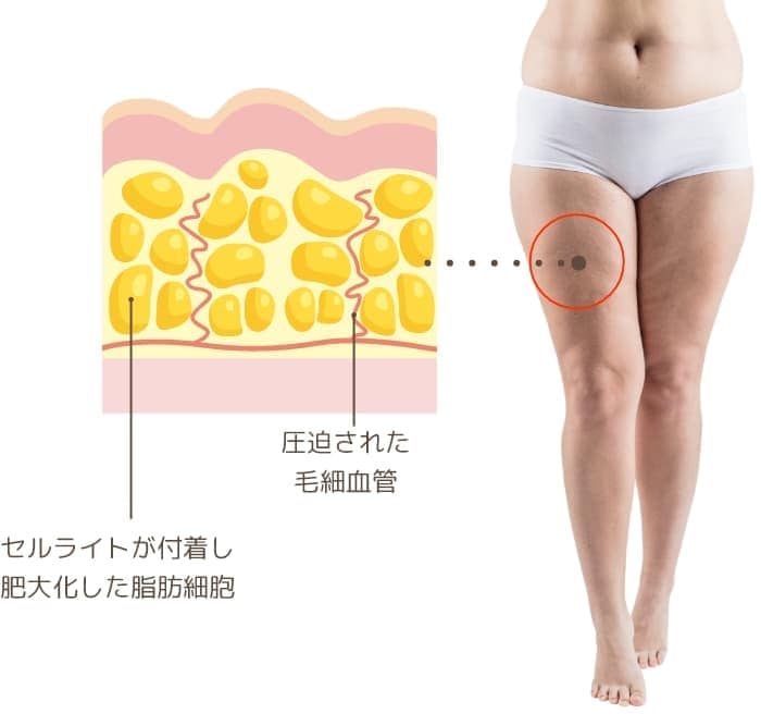 セルライトをゴリゴリ攻める！汗だくセルライトproコースをお得に体験