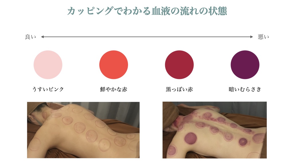 カッサ&カッピング効果 - Valerian