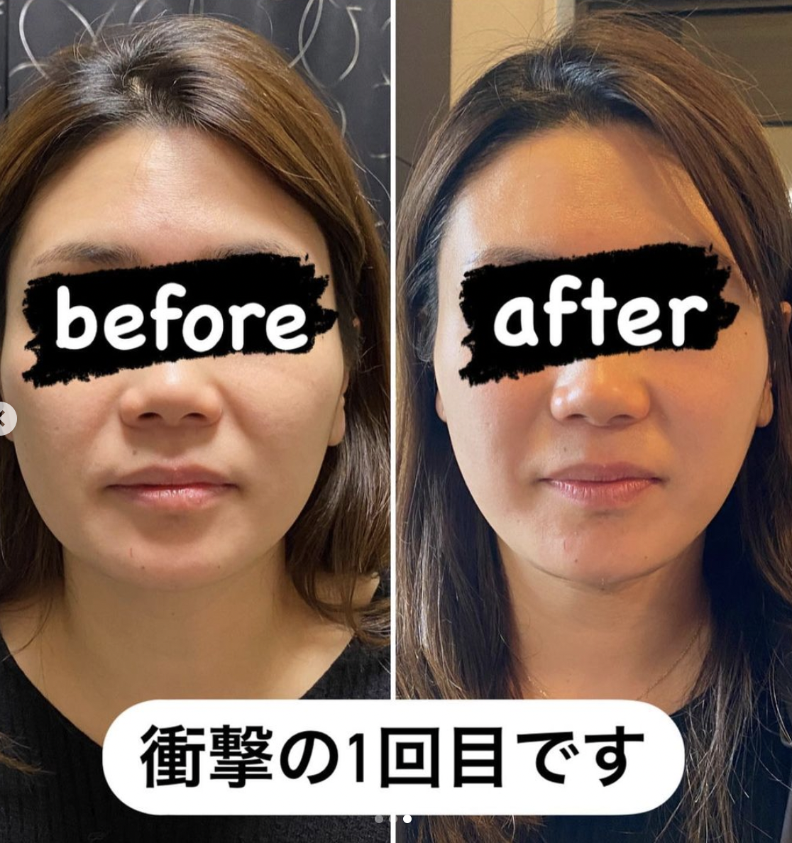 業務用ハイフ】フォーカスネオの価格・リース・レンタルは？口コミや