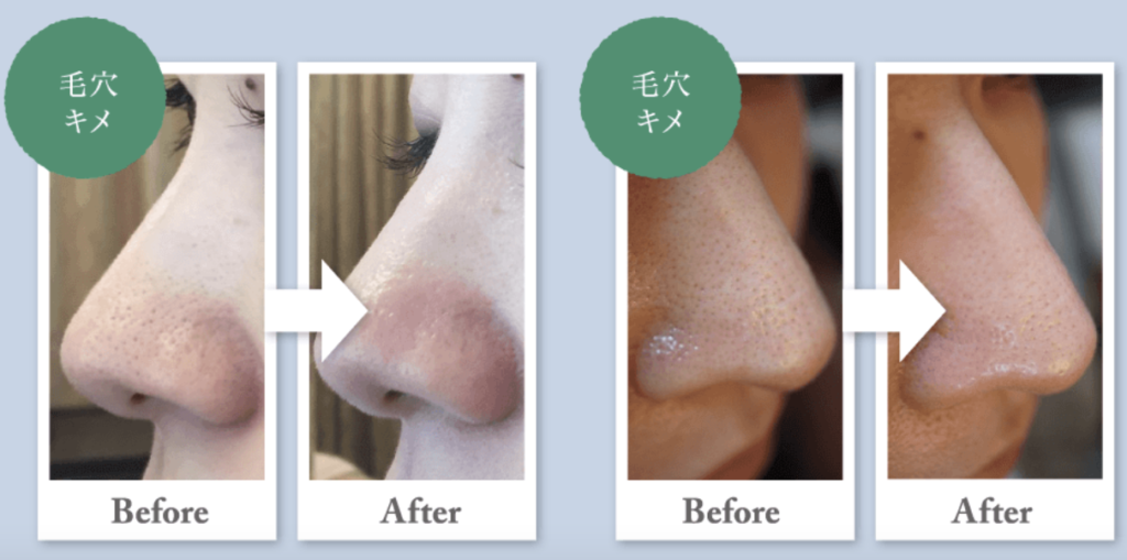 業務用フェイシャル美容機器｜アクアエラの特徴や効果、価格についてご