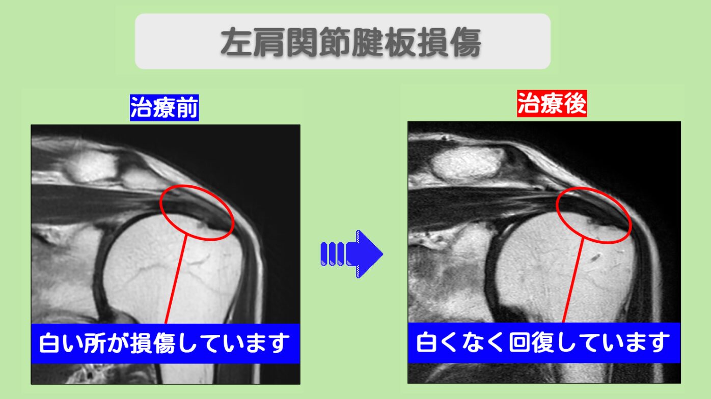 MRIで腱板損傷の回復を確認、痛みはゼロに！左肩腱板損傷 70代男性