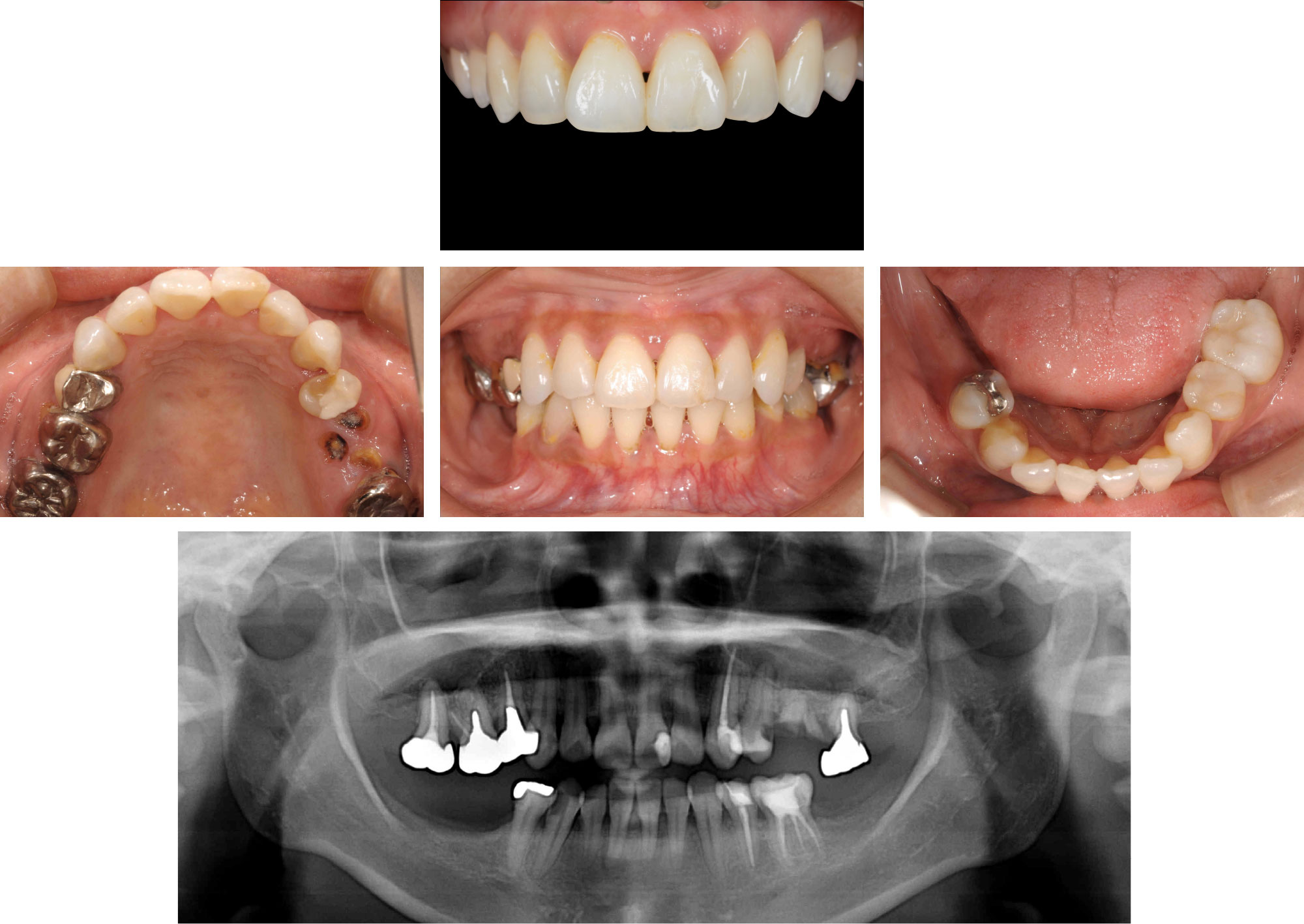 インプラントによる歯科治療｜岡山のインプラント治療ならアイデンタル
