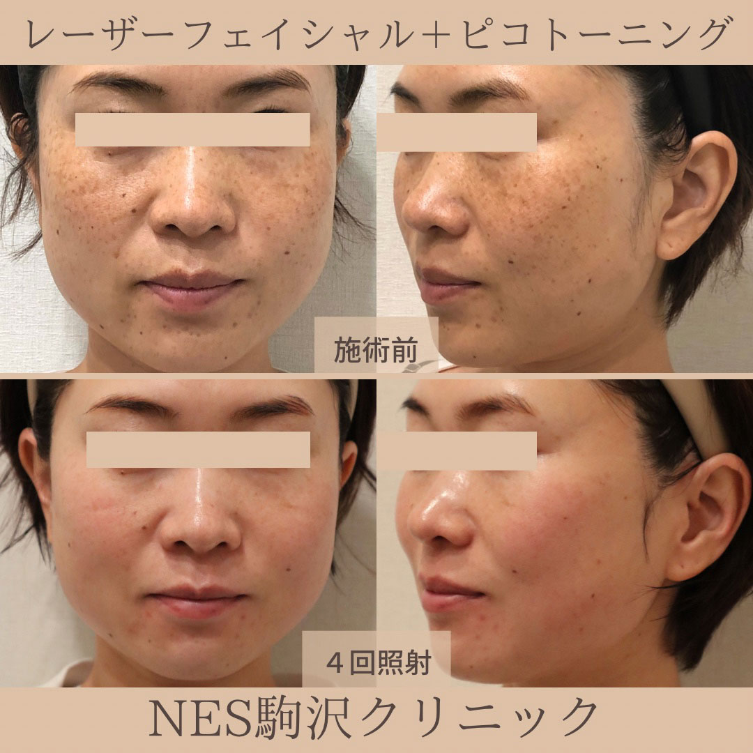 世田谷でシミ取り治療はネス駒沢クリニック 形成外科・美容 | 駒沢の